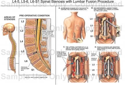 Lumbar Spinal Stenosis Treatment Options