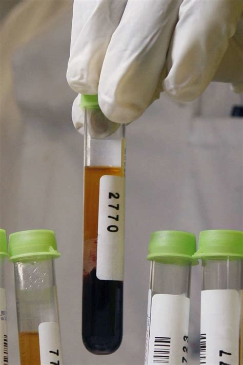 Blood Tests for Rheumatoid Arthritis