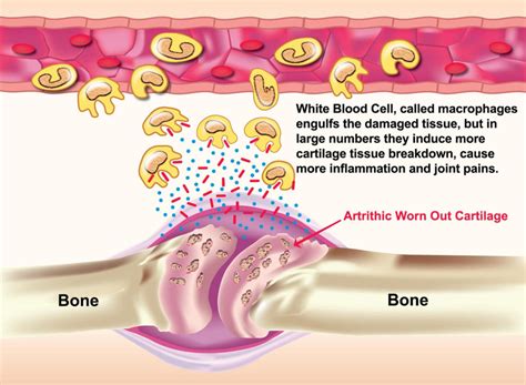 Joint Inflammation Illustration
