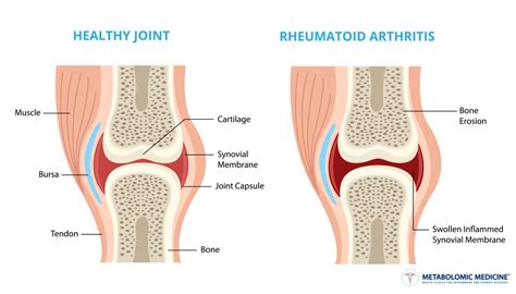 Rheumatoid Arthritis Joint