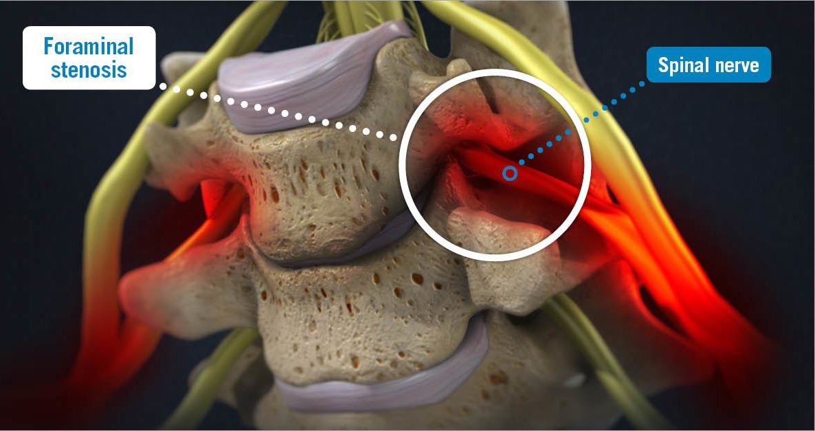 Cervical Spinal Stenosis Illustration