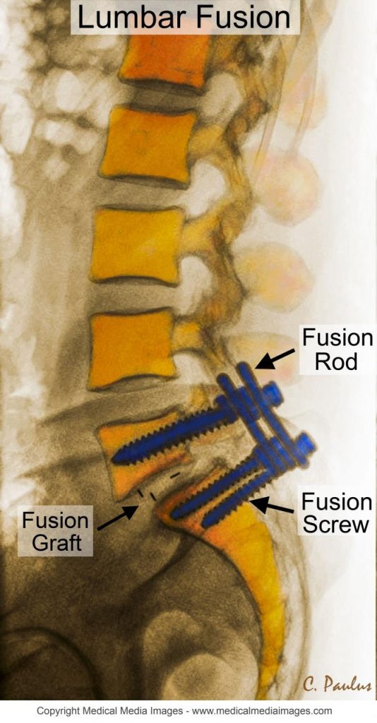 What is Lumbar Spinal Fusion Surgery?
