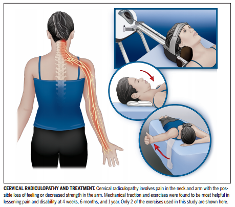 Exploring Non-Surgical Treatments for Cervical Radiculopathy: Therapy and Pain Management Options