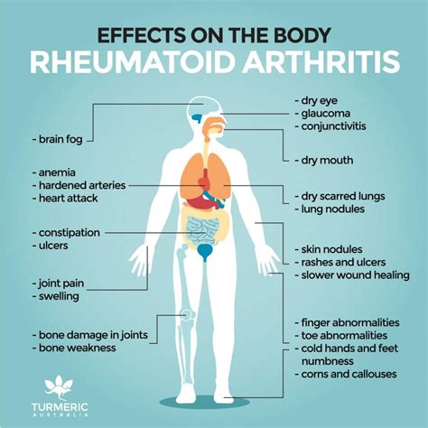 Rheumatoid Arthritis: Understanding Its Symptoms and Impact - Becker Spine