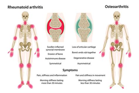 Rheumatoid Arthritis: Understanding Symptoms, Causes, and Best Treatment Options