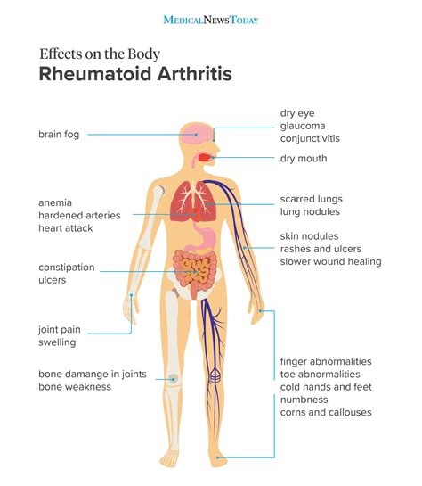 Rheumatoid Arthritis: Understanding Symptoms, Causes, and Complications