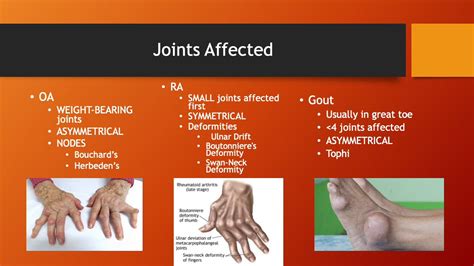 Rheumatoid Arthritis vs. Gout: Understanding the Key Differences