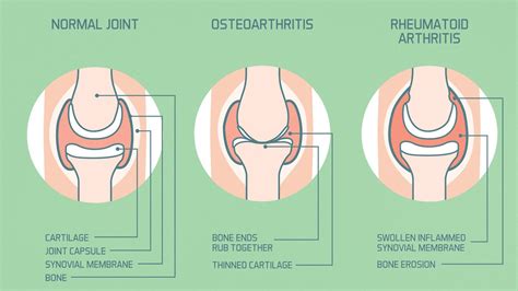Rheumatoid Arthritis vs. Other Arthritis Types