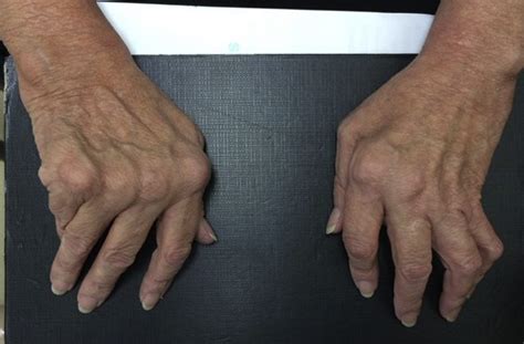 Understanding and Managing Hand Deformities in Rheumatoid Arthritis