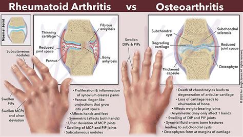 Understanding Arthritis: Osteoarthritis vs. Rheumatoid Arthritis - What ...