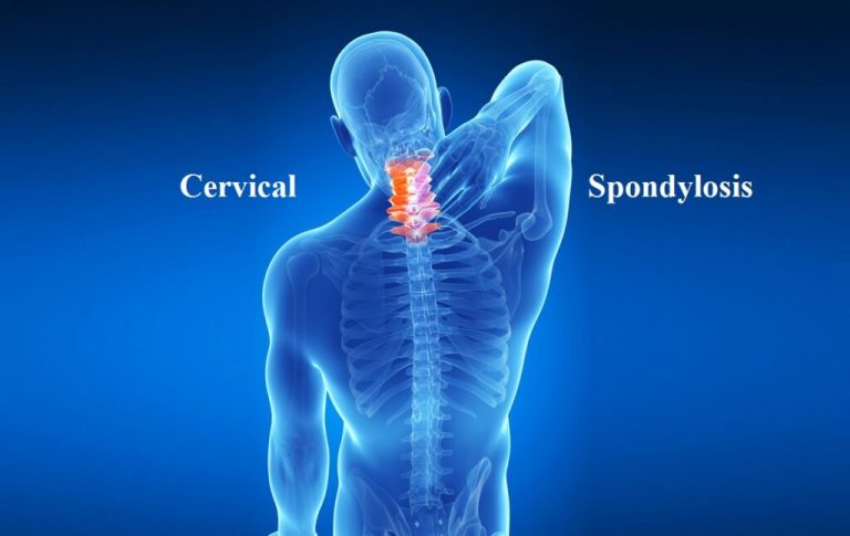 Understanding Cervical Spondylosis Symptoms Causes And Treatment Becker Spine