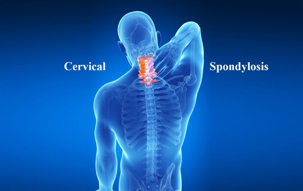 Understanding Cervical Spondylosis