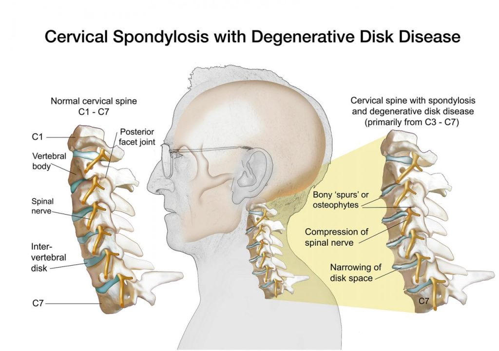 Understanding Degenerative Spine Conditions