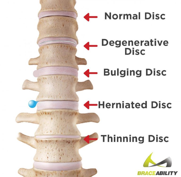 Understanding Herniated Discs And Degenerative Disc Disease Symptoms And Treatment Options