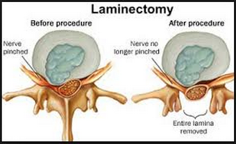 Understanding Lumbar Laminectomy