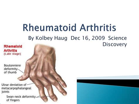 Understanding Rheumatoid Arthritis: Clinical Presentation and Management