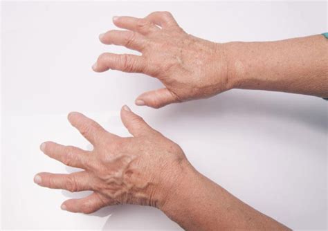Understanding Rheumatoid Arthritis: Diagnosis, Treatment, and Management