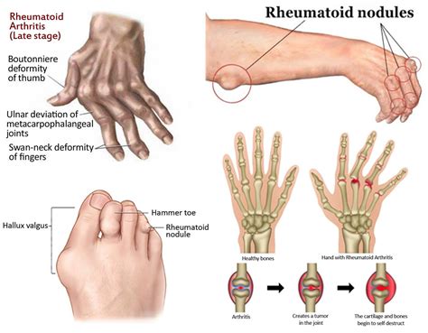 Understanding Rheumatoid Arthritis Hand Deformities: Causes and Management
