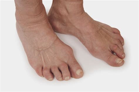 Understanding Rheumatoid Arthritis in Feet: Symptoms, Treatments, and More
