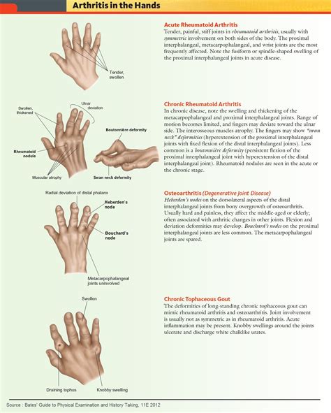 Rheumatoid Arthritis in Hands