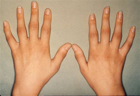Understanding Rheumatoid Arthritis Swelling: Causes and Effective Treatments