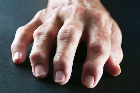 Understanding Rheumatoid Arthritis Through Images: A Visual Guide