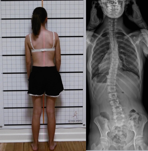 Understanding Scoliosis: Symptoms, Types, and Treatment Options