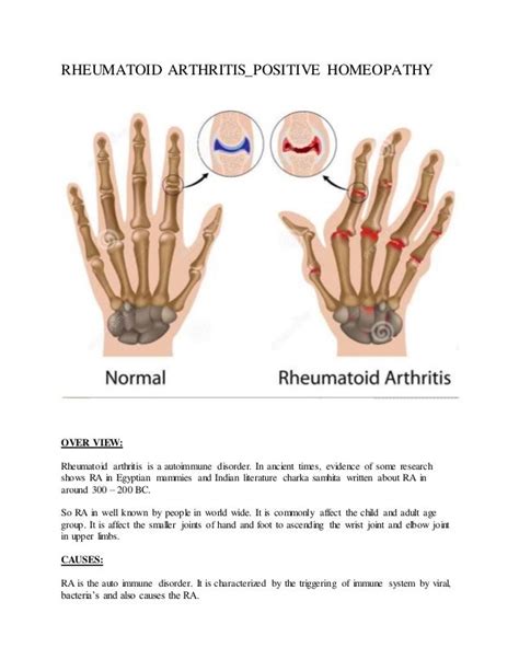 Understanding Seropositive Rheumatoid Arthritis
