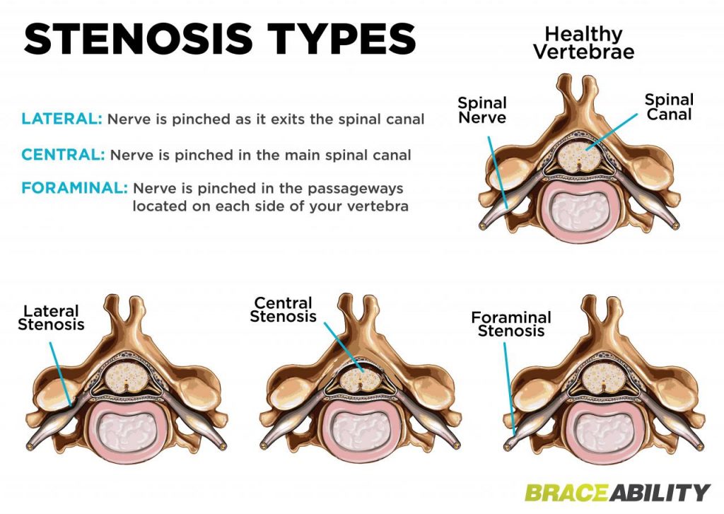 Understanding Spinal Stenosis