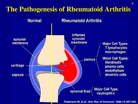 Understanding the Pathogenesis and Clinical Presentation of Rheumatoid Arthritis