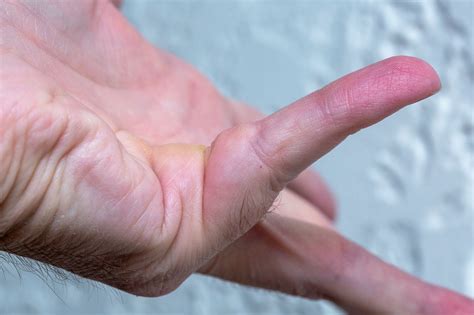 Understanding Trigger Finger