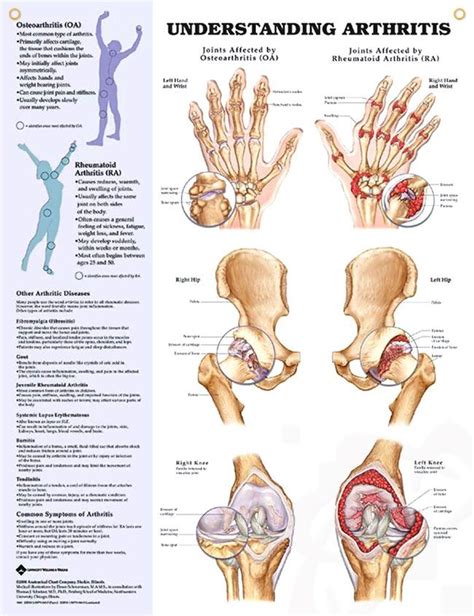 Rheumatoid Arthritis Joints