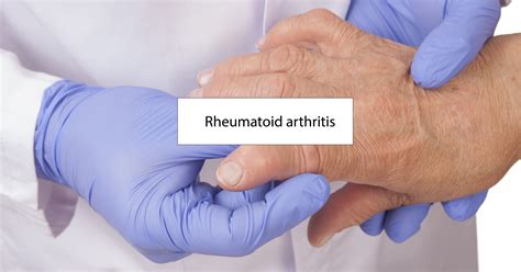 Can Rheumatoid Arthritis Lead to a Shortened Lifespan?