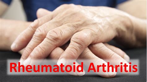 Rheumatoid Arthritis Solutions