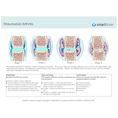 Rheumatoid Arthritis: Understanding Symptoms, Causes, and Advanced Treatments