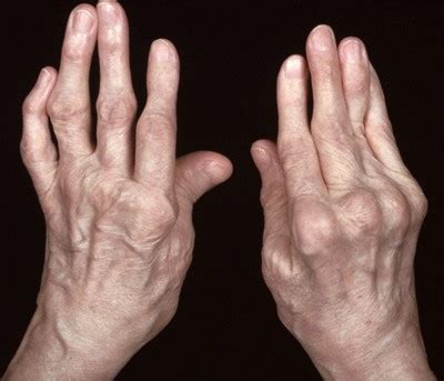 Understanding and Managing Rheumatoid Arthritis: Diagnosis, Symptoms, and Treatment Options