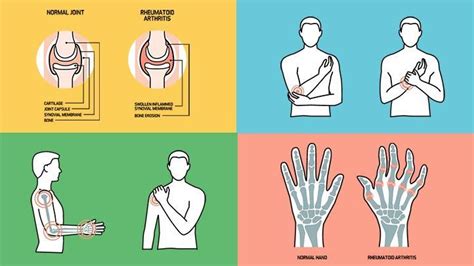 Understanding and Preventing Rheumatoid Arthritis: Strategies and Challenges