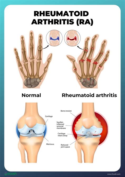 Understanding Arthritis: Symptoms and Differences Between Osteoarthritis and Rheumatoid Arthritis