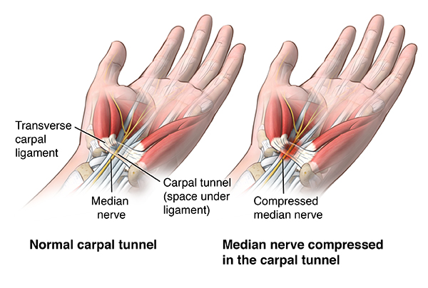 Understanding Carpal Tunnel Syndrome: Symptoms, Causes, and Treatment Options