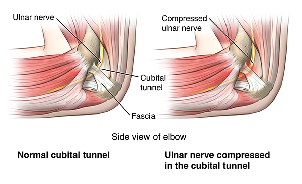 Understanding Cubital Tunnel Syndrome: Causes, Symptoms, and Treatments