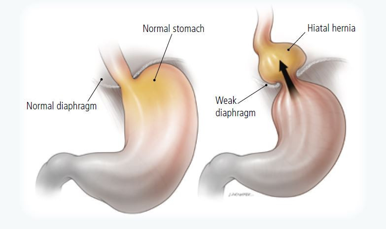 Understanding Gastroesophageal Reflux Disease (GERD): Symptoms and Treatment Options