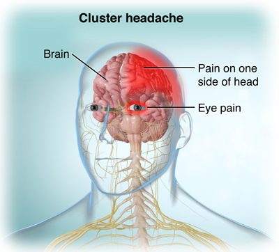 Understanding Headaches: Causes, Types, and Treatment Options