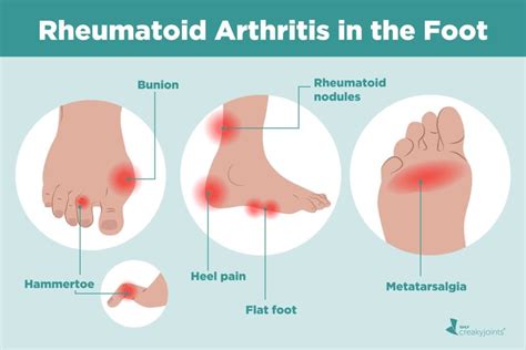 Understanding Rheumatoid Arthritis in Feet: Symptoms, Treatments, and Visual Guide