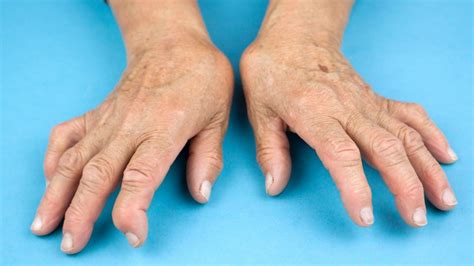 Understanding Rheumatoid Arthritis in Hands