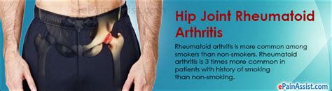 Understanding Rheumatoid Arthritis in Hips