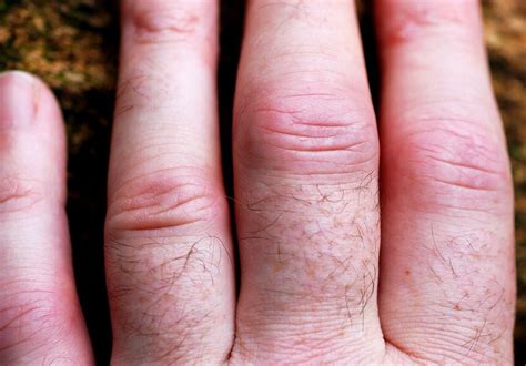 Understanding Rheumatoid Arthritis in Young Adults: What You Need to Know