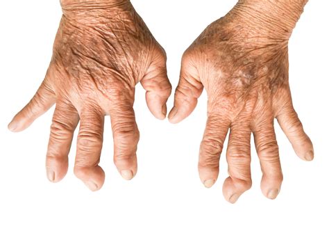 Understanding Rheumatoid Arthritis: Symptoms and Causes