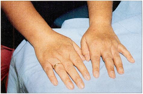 Understanding Rheumatoid Arthritis: Symptoms, Stages, and Treatment Options