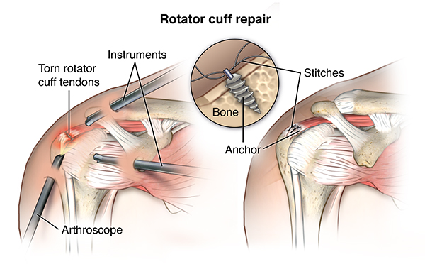 Understanding Rotator Cuff Injuries: Causes, Symptoms, and Treatments