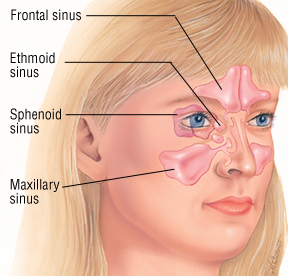 Understanding Sinusitis: Causes, Symptoms, and Treatment Options
